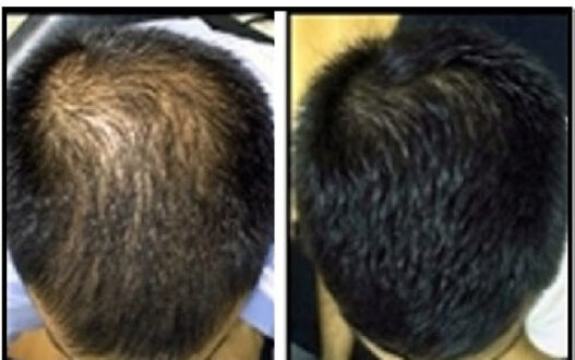 hair-loss-treatment-therapy