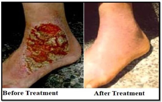 tinea-treatment-fungal-infection