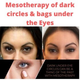 Mesotherapy of dark circles & bags under the eyes