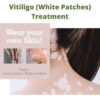 Vitiligo (White Patches) Treatment