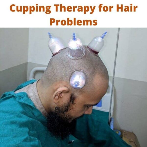 Cupping Therapy for Hair Problems