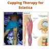 Cupping Therapy for Sciatica
