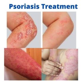 Psoriasis Treatment