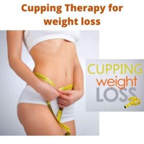 Cupping Therapy for weight loss