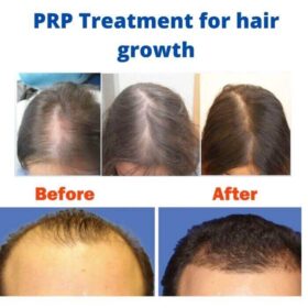 PRP Treatment for hair growth