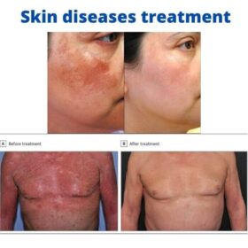 Skin diseases treatment