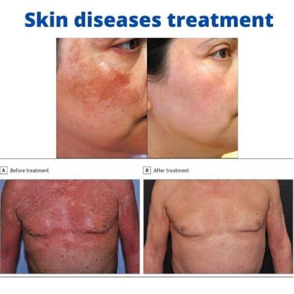 Skin diseases treatment