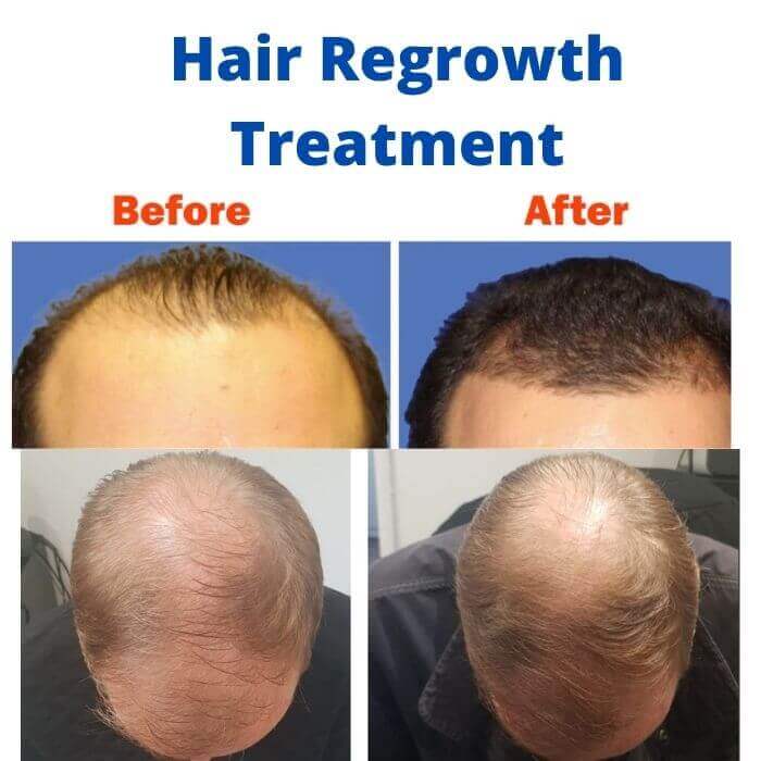 Hair Regrowth Treatment – Skin Hair and Pain Treatment