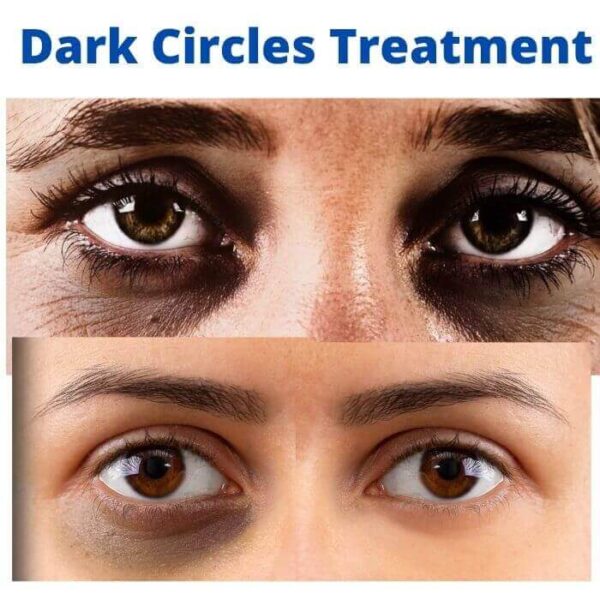 dark circle treatment