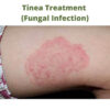 Tinea Treatment (Fungal Infection)