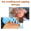 Dry needling and cupping therapy