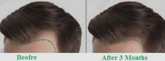 Hair Loss Treatment Benefits