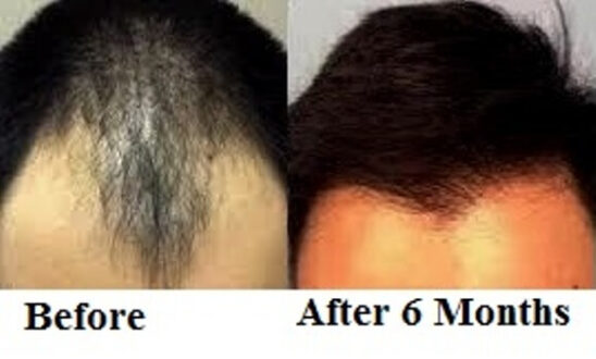 Hair Fall/Hair Loss Treatment Before and After