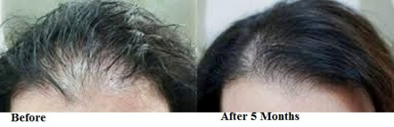 How much Time is required to See Results from Hair Loss Treatments?